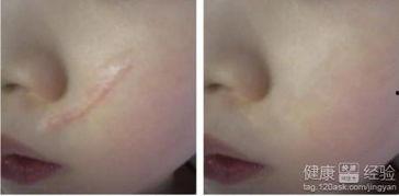 国产祛疤偏方大全视频,传统智慧与现代疗法的完美融合