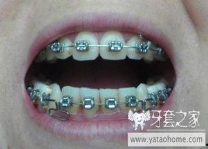 牙套国产图片大全集视频,揭秘最新口腔矫正潮流