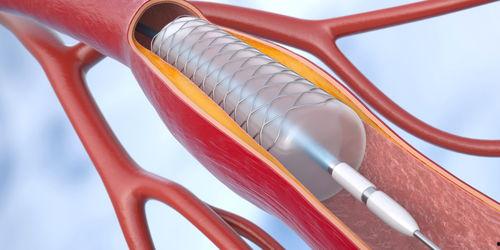 国产心脏支架视频,国产替代之路的里程碑