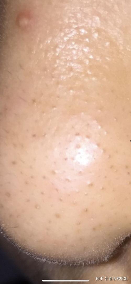 国产黑头去除视频大全,轻松告别毛孔堵塞